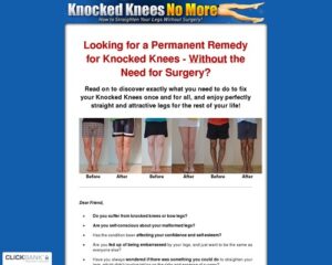 Knocked Knees No Far more – How to Straighten Your Legs With out Surgical procedures!